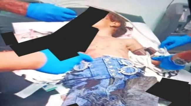 إصابة طفلة بانفجار مقذوف من مخلفات النزاع في الضالع